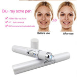 Laser Pen for Soft Scar Wrinkle Removal Treatment
