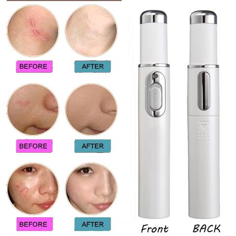 Laser Pen for Soft Scar Wrinkle Removal Treatment