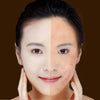 Laser Pen for Soft Scar Wrinkle Removal Treatment
